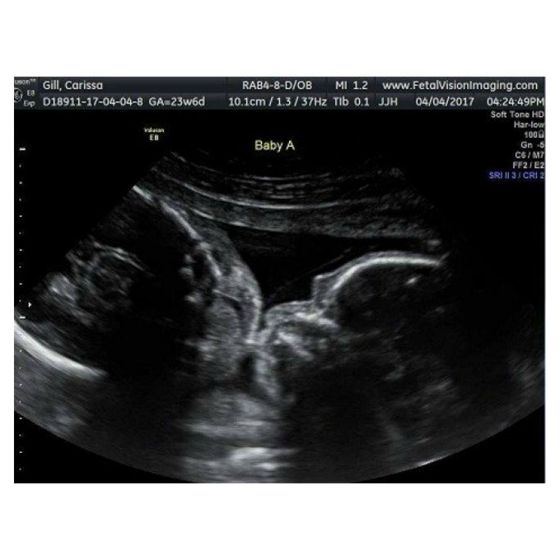 Ultrasound Shows Moment Twins Appear To Be Kissing In Womb 8277