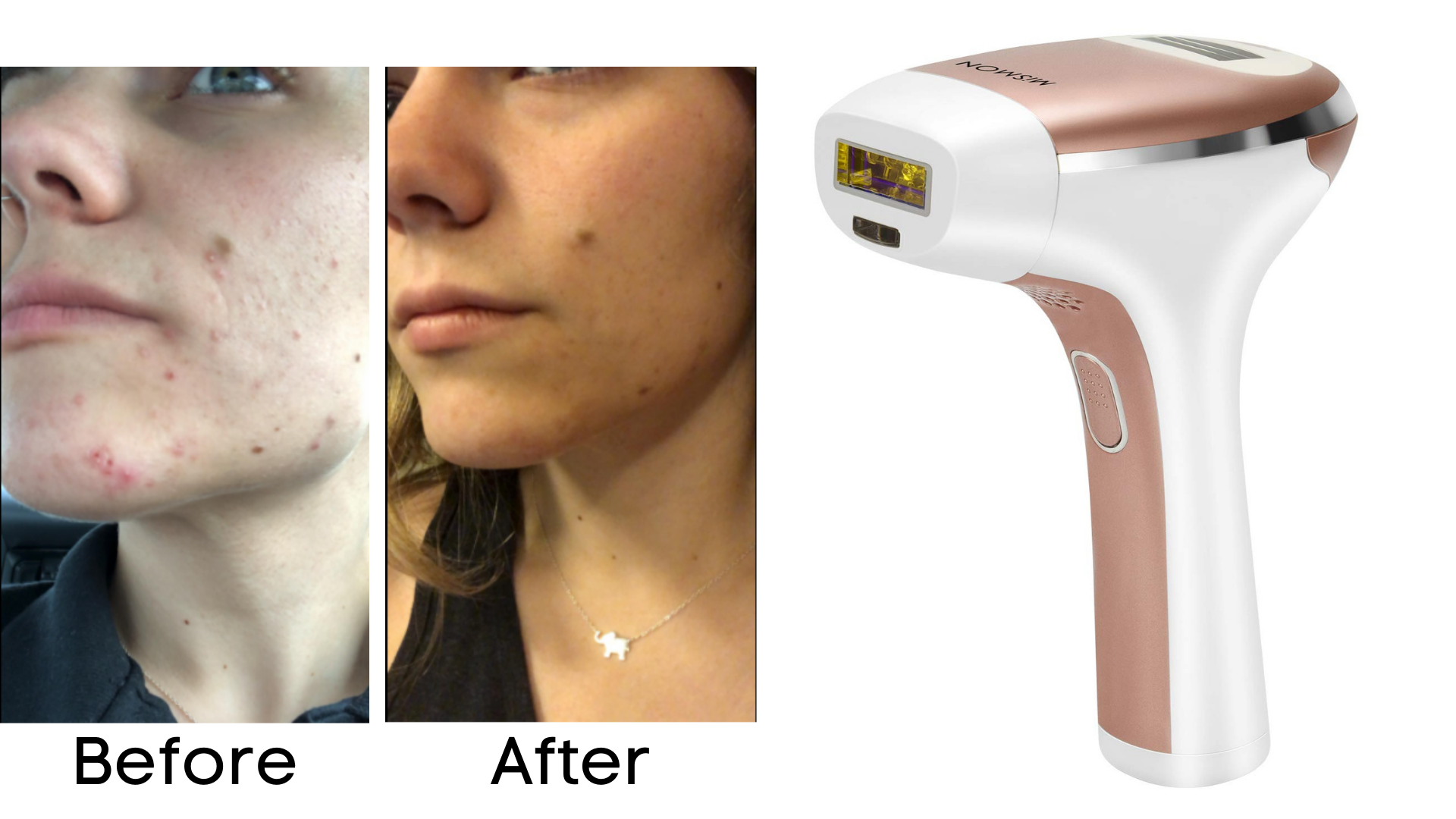 At home laser hair deals removal before and after