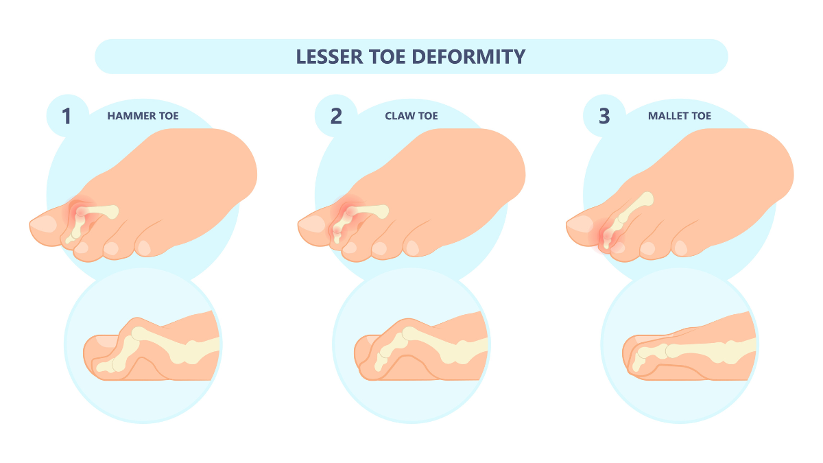 Understand Crooked Toes, Types and Treatment