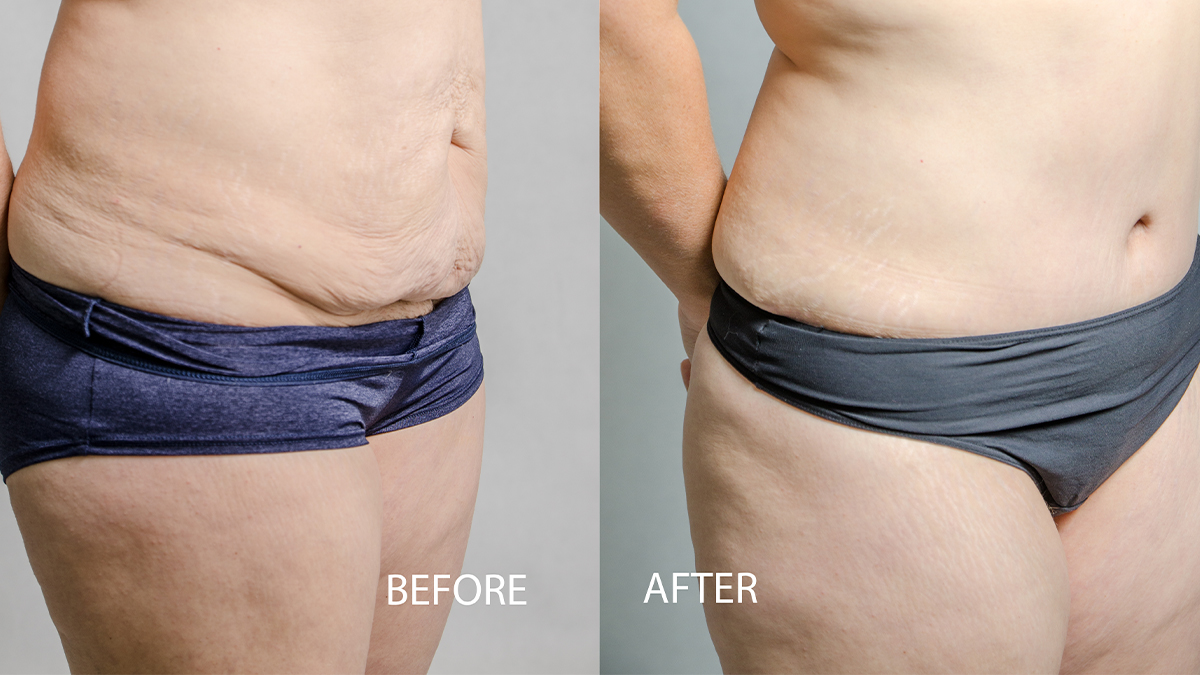Tummy Tuck Before and After: Top Surgeon Weighs In