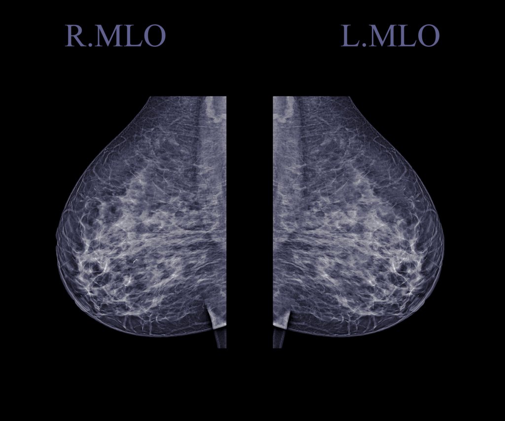 mammogram results showing dense breast tissue