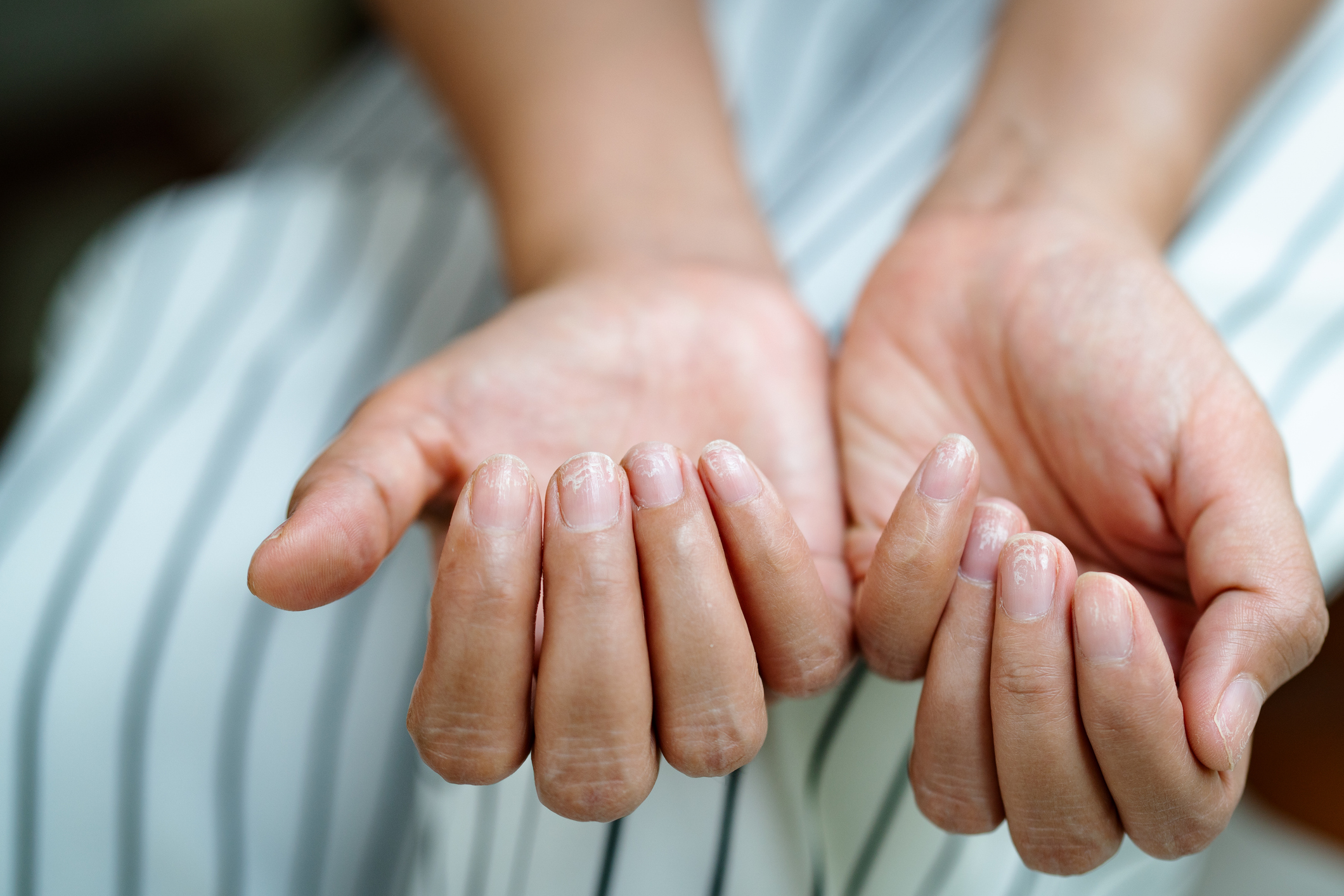 damaged nails