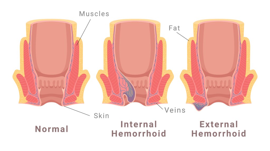 an illustration of of internal and external hemorrhoids, which do itch