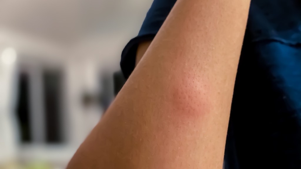 A close-up of a woman's arm with a mosquito bite on it