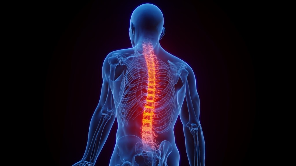 An illustration of an irritated spine with osteoarthritis