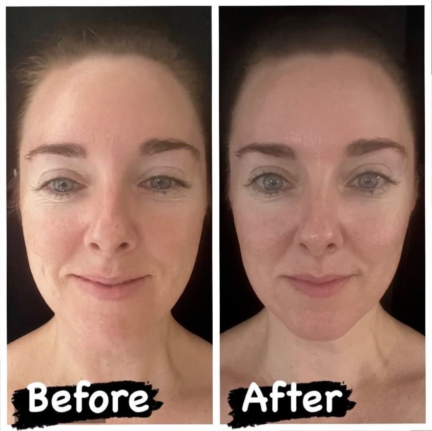 Gua sha before and after