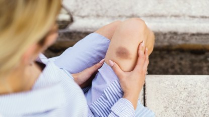 A close-up of a blonde woman outdoors holding her leg, which has a bruise