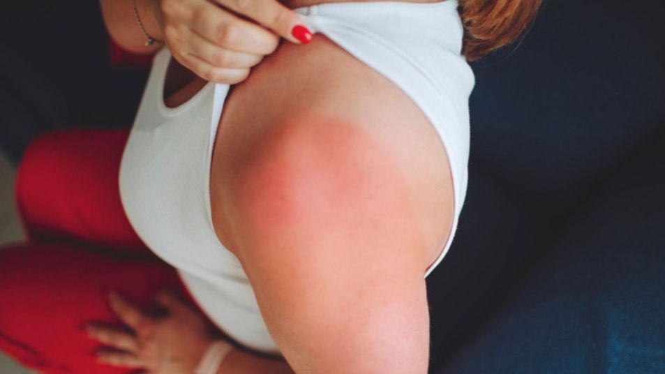 Close-up of a woman with a red, irritated heat rash on her shoulder that she wants to get rid of quickly
